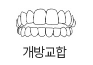 개방교합